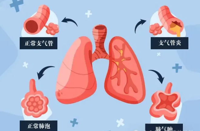 灵芝孢子油对哮喘及肺气肿的作用