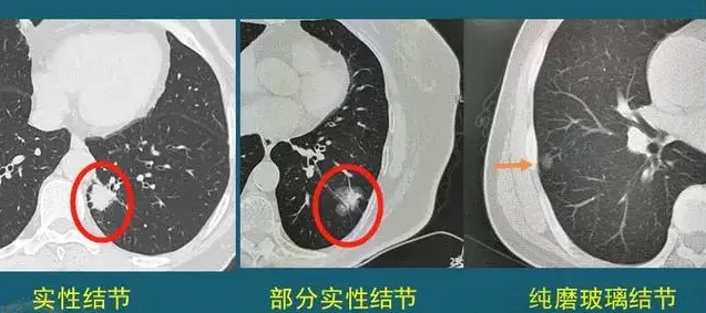 灵芝孢子油对肺结节的调理作用